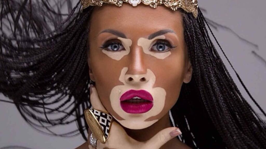 Vitiligo-resumen